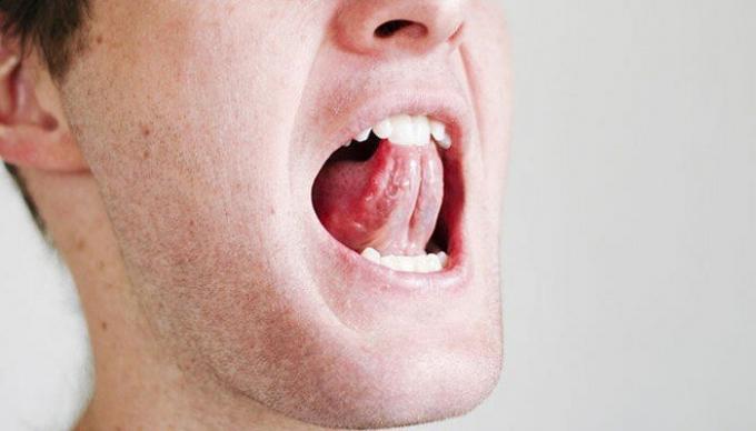 Unos ejercicios sencillos para la garganta y la lengua puede aliviar la situación con los ronquidos. / Foto: i2.wp.com. 